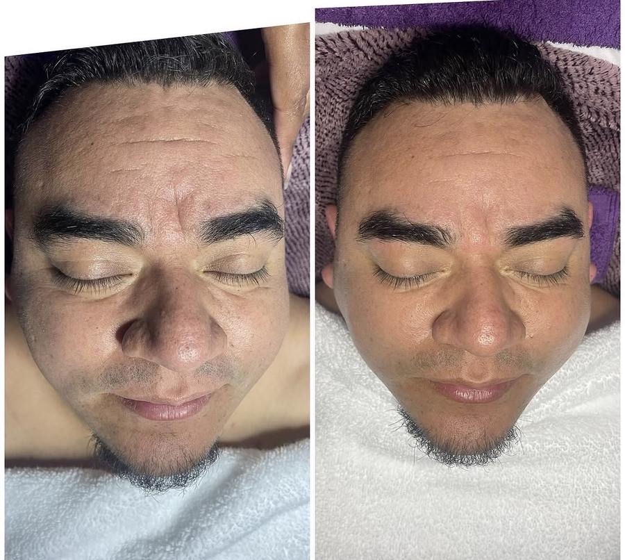 Facial treatment before and after