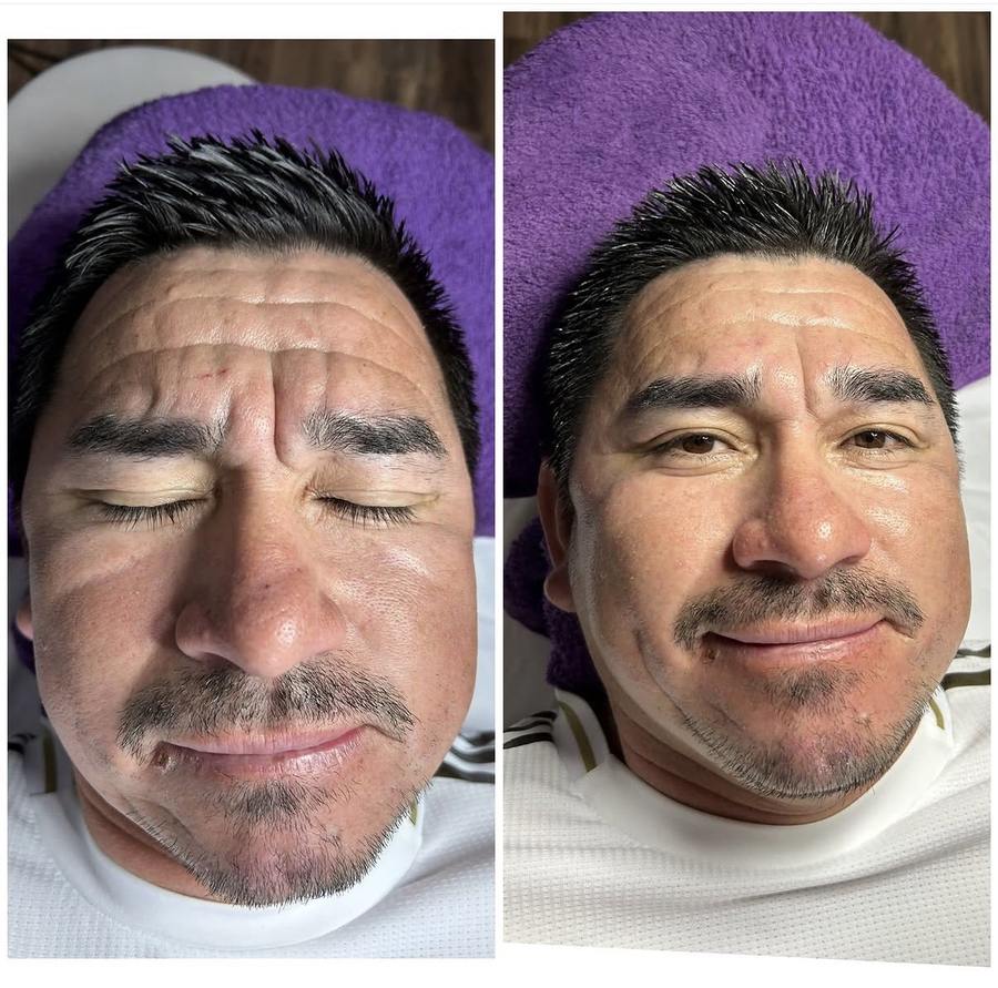 Anti-aging facial before and after