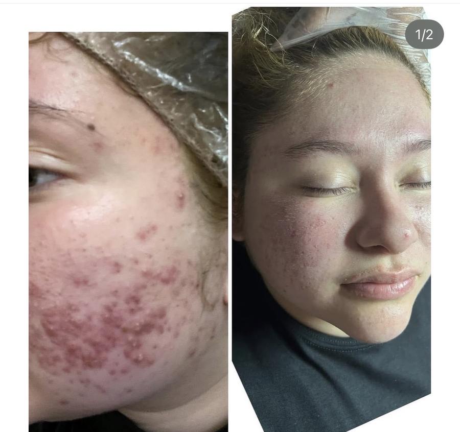 Acne facial before and after