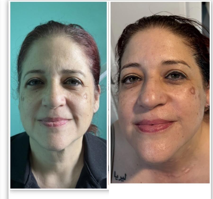 Skin brightening before and after