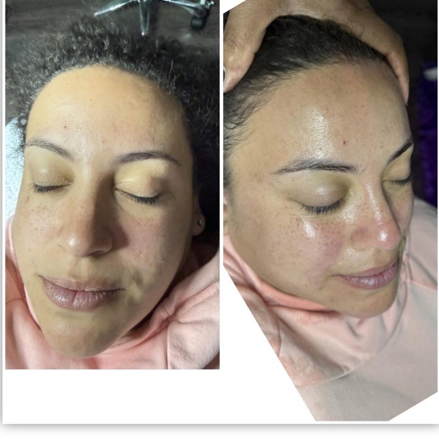 Hydrating facial before and after